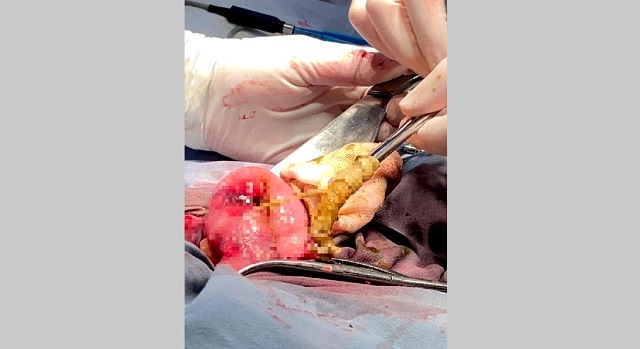 120-сантиметрового ленточного червя удалили из кишечника пациента врачи в Уфе