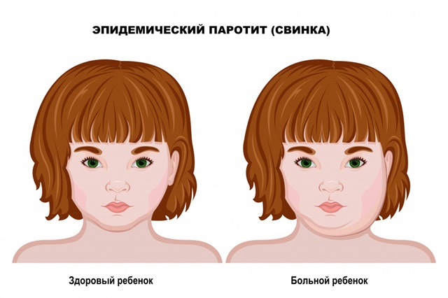 Жителям Татарстана озвучили симптомы эпидемического паротита и меры его профилактики