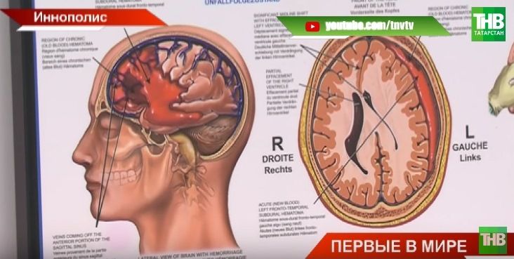 Ученые из Иннополиса в Татарстане разработали код, который может предсказать приступ эпилепсии (ВИДЕО)