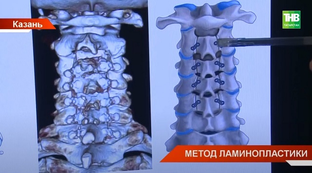 Молодой нейрохирург РКБ впервые в Татарстане провел уникальную операцию на спинном мозге