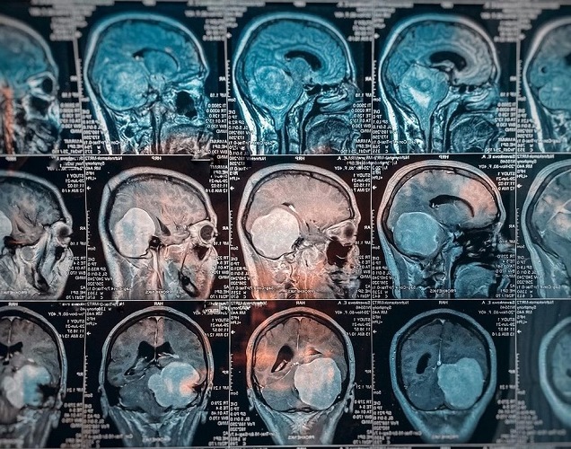 В Казани врачи РКБ удалили женщине гигантскую опухоль головного мозга