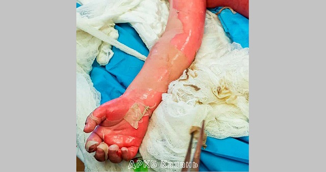 В Казани врачи ДРКБ спасли двухлетнего ребенка с 73-процентным ожогом тела