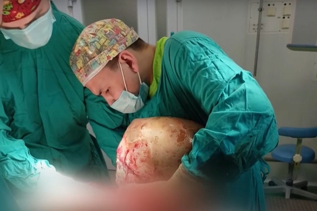 20-килограммовую кисту, камни и грыжу удалили пациентке врачи РКБ в Казани