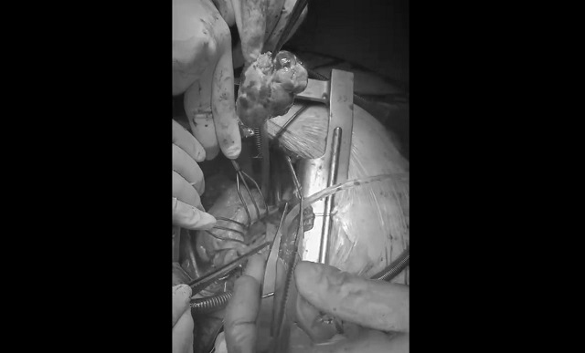 В Набережных Челнах врачи БСПМ удалили из сердца пожилой пациентки гигантскую опухоль