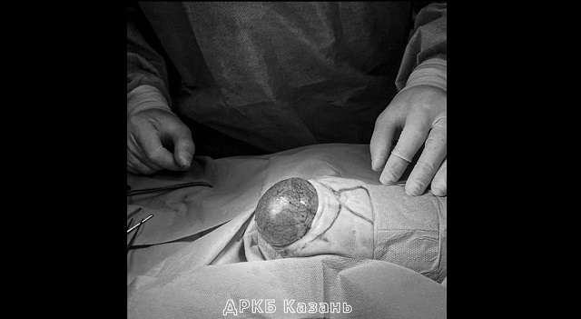 В Казани врачи ДРКБ удалили «вколоченную» в малый таз новорожденного тератому