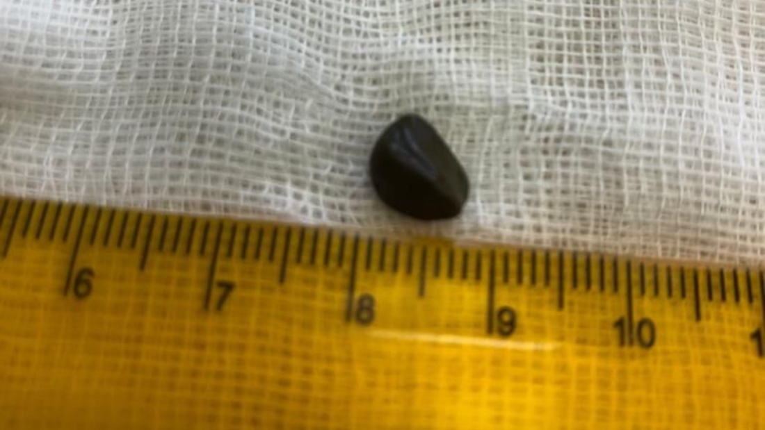 Врачи ДРКБ извлекли застрявший в бронхе малыша 7-миллиметровый камень